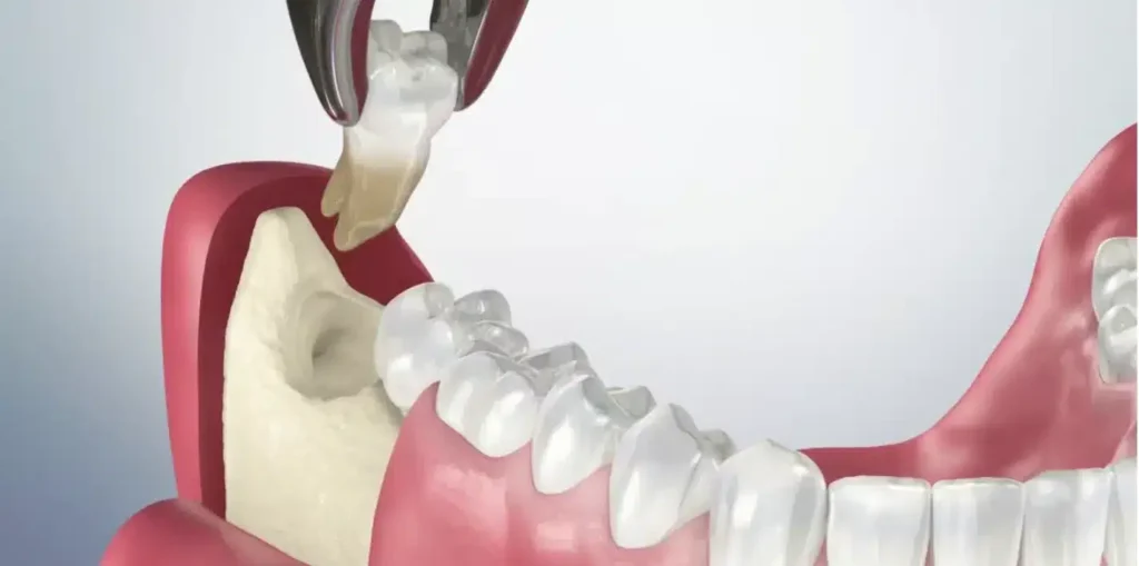 Hình 1: Răng khôn nằm ở phía trong cùng của khoang miệng