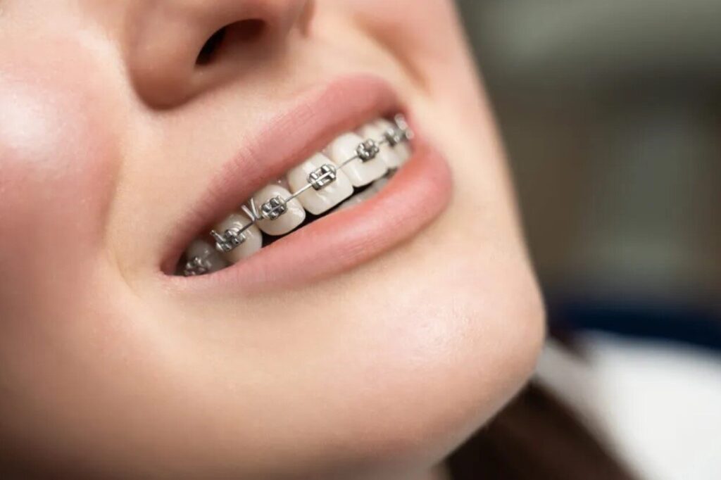 Hình 1: Niềng răng mắc cài là phương pháp chỉnh nha được áp dụng cho nhiều trường hợp gặp khuyết điểm về răng