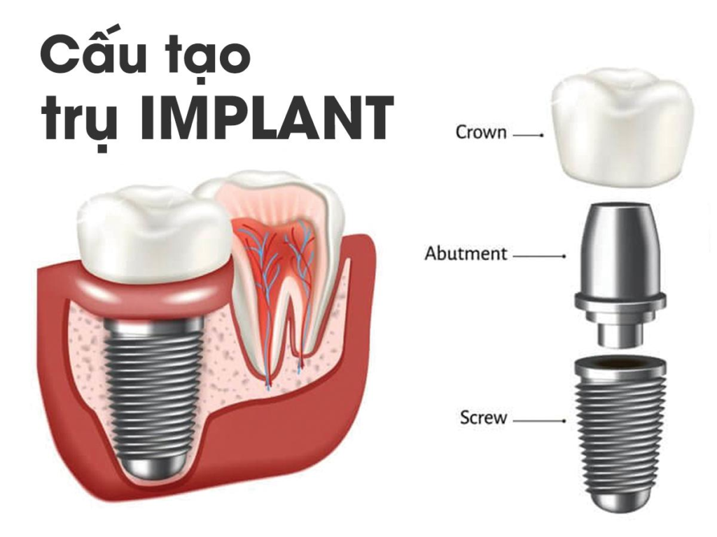 Hình 2: Cấu tạo chi tiết của răng Implant