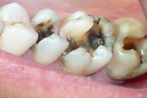 Nhổ răng hàm trên bị sâu – Quy trình, chi phí và chăm sóc