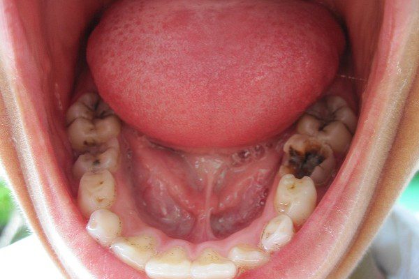 Nhổ răng hàm trên bị sâu Quy trình, chi phí và chăm sóc
