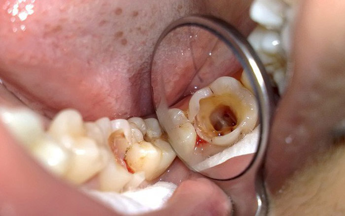 Nhổ răng hàm trên bị sâu Quy trình, chi phí và chăm sóc