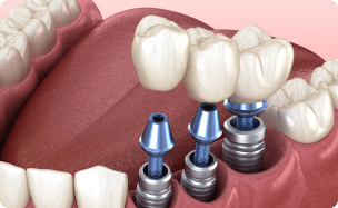 Trồng răng Implant 17 dich vu trong 1 vai rang implant