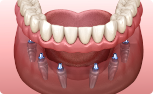 Trồng răng Implant 18 dich vu trong rang implant toan ham