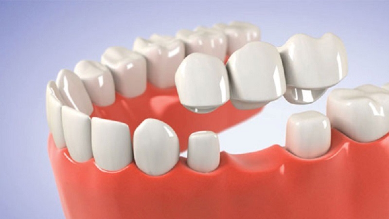 Giải đáp bắc cầu răng sứ có bền không? Các yếu tố ảnh hưởng 1 bắc cầu răng sứ có bền không