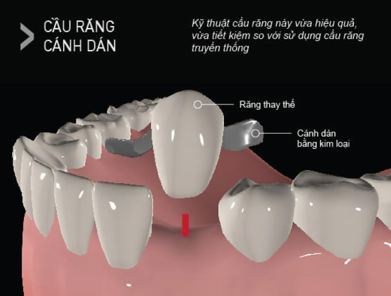 Giải đáp bắc cầu răng sứ có bền không? Các yếu tố ảnh hưởng 2 bắc cầu răng sứ có bền không