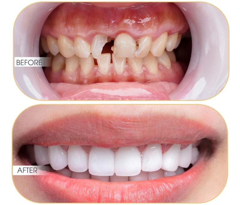 Giải đáp bắc cầu răng sứ có bền không? Các yếu tố ảnh hưởng 3 bắc cầu răng sứ có bền không
