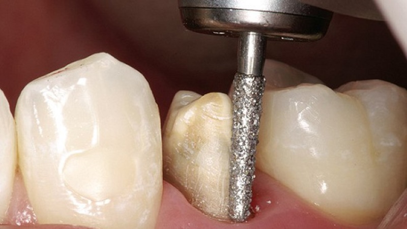Giải đáp bắc cầu răng sứ có bền không? Các yếu tố ảnh hưởng 4 bắc cầu răng sứ có bền không