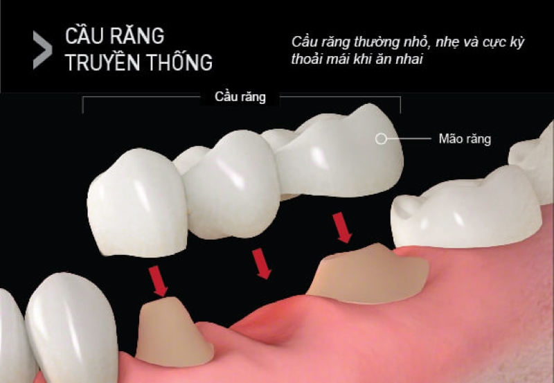 Giải đáp bắc cầu răng sứ có bền không? Các yếu tố ảnh hưởng 5 bắc cầu răng sứ có bền không