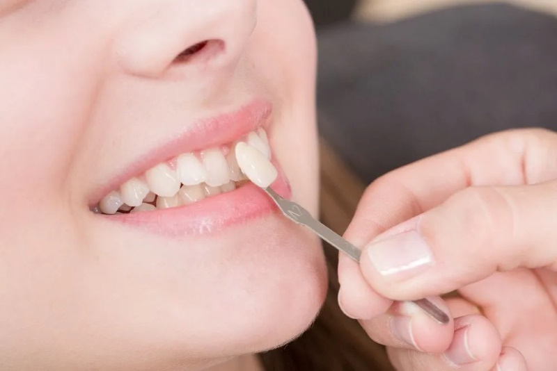 bắc cầu răng sứ có bền không