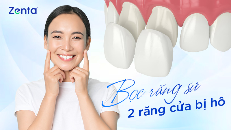 boc rang su 2 rang cua bi ho