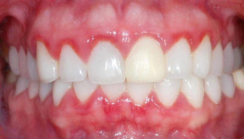 Bọc răng sứ bị viêm lợi - Dấu hiệu, nguyên nhân và cách khắc phục 1 bọc răng sứ bị viêm lợi