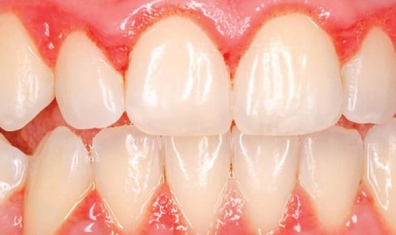 Bọc răng sứ bị viêm lợi - Dấu hiệu, nguyên nhân và cách khắc phục 3 bọc răng sứ bị viêm lợi