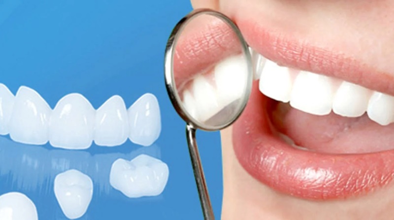 Bọc răng sứ bị viêm lợi - Dấu hiệu, nguyên nhân và cách khắc phục 4 bọc răng sứ bị viêm lợi