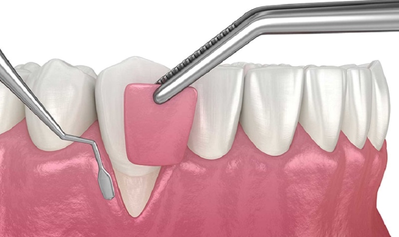 Bọc răng sứ bị viêm lợi - Dấu hiệu, nguyên nhân và cách khắc phục 6 bọc răng sứ bị viêm lợi