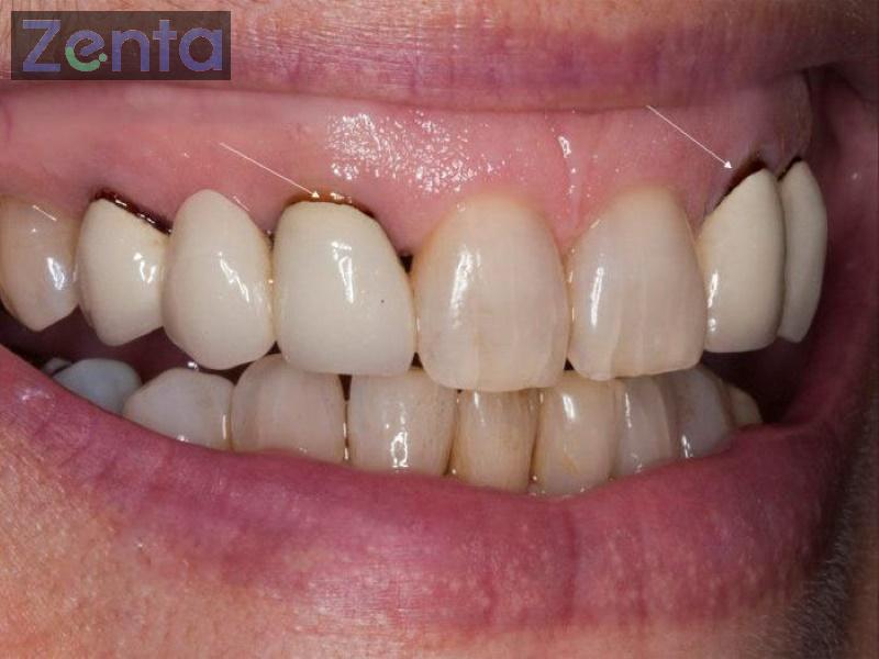 Bọc răng sứ có bị hôi miệng không? Nguyên nhân và cách xử lý 2 boc rang su co bi hoi mieng khong 3