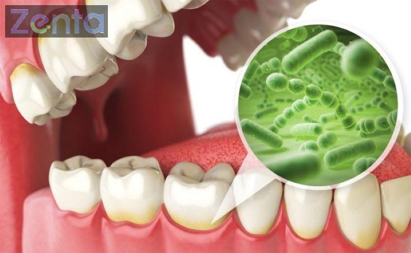 Bọc răng sứ có bị hôi miệng không? Nguyên nhân và cách xử lý 3 làm răng sứ có hôi miệng không