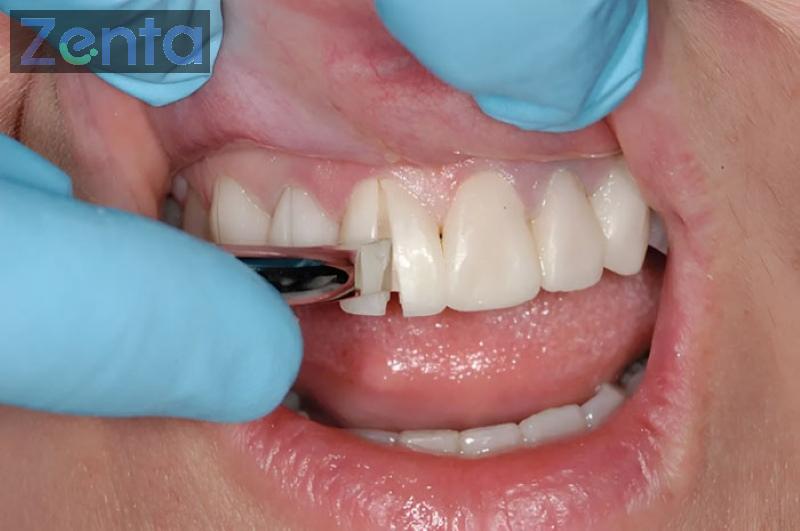 Bọc răng sứ có bị hôi miệng không? Nguyên nhân và cách xử lý 5 bọc răng sứ có bị hôi miệng không