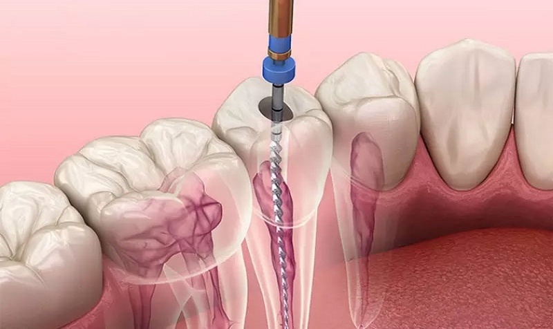 Bọc răng sứ có lấy tủy không? Khi nào cần và không cần lấy tủy khi bọc sứ? 1 bọc răng sứ có lấy tủy không