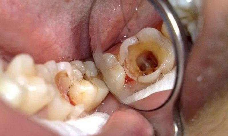 Bọc răng sứ có lấy tủy không? Khi nào cần và không cần lấy tủy khi bọc sứ? 3 bọc răng sứ có lấy tủy không