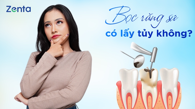 Bọc răng sứ có lấy tủy không