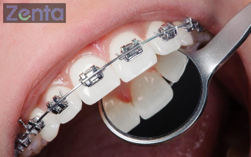Bọc răng sứ có niềng răng được không? Trường hợp chỉ định niềng 1 làm răng sứ có niềng răng được không