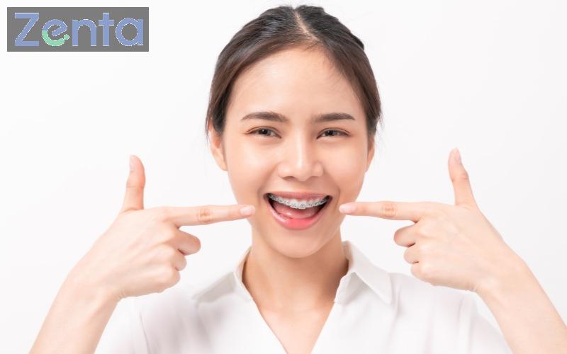 Bọc răng sứ có niềng răng được không? Trường hợp chỉ định niềng 2 bọc răng sứ có niềng răng được không