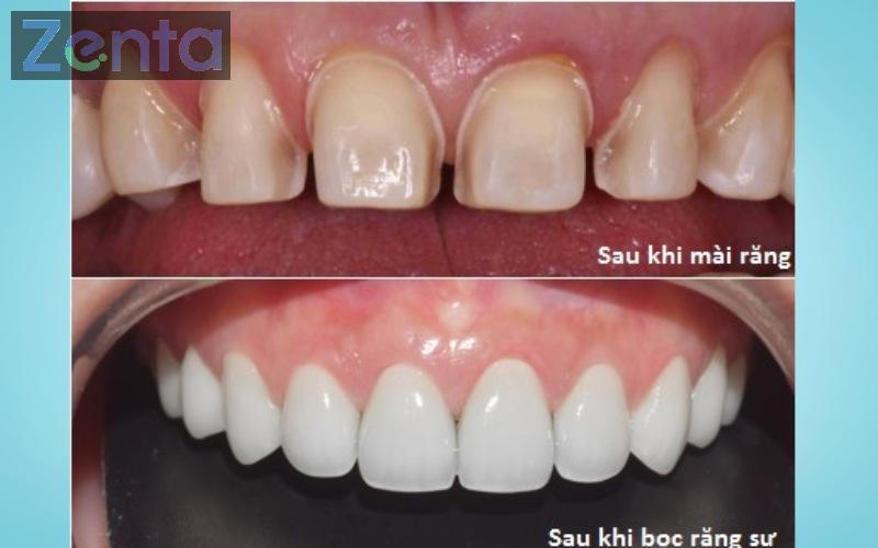 Bọc răng sứ có niềng răng được không? Trường hợp chỉ định niềng 3 bọc răng sứ có niềng răng được không