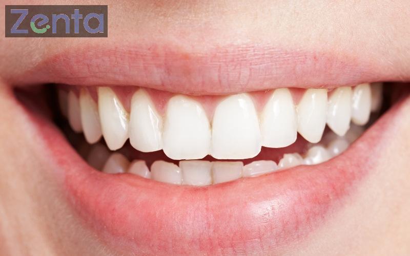 Bọc răng sứ có niềng răng được không? Trường hợp chỉ định niềng 4 răng bọc sứ có niềng được không