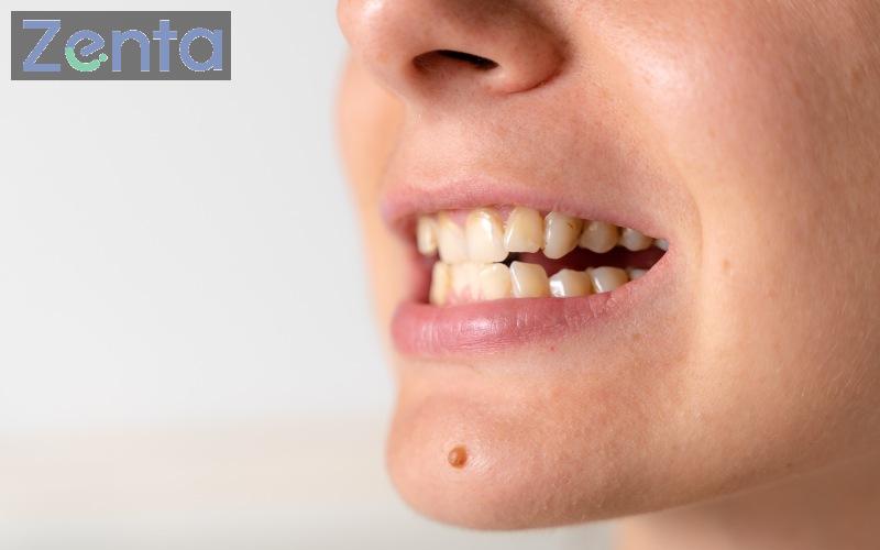 Bọc răng sứ có niềng răng được không? Trường hợp chỉ định niềng 5 làm răng sứ có niềng răng được không