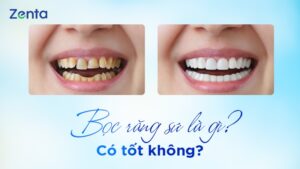 Bọc răng sứ là gì
