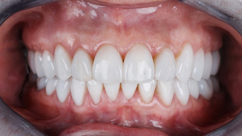 Bọc răng sứ mất bao lâu thì xong? Các yếu tố ảnh hưởng thời gian 1 bọc răng sứ mất bao lâu
