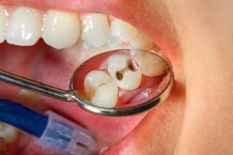 Bọc răng sứ mất bao lâu thì xong? Các yếu tố ảnh hưởng thời gian 3 bọc răng sứ mất bao lâu